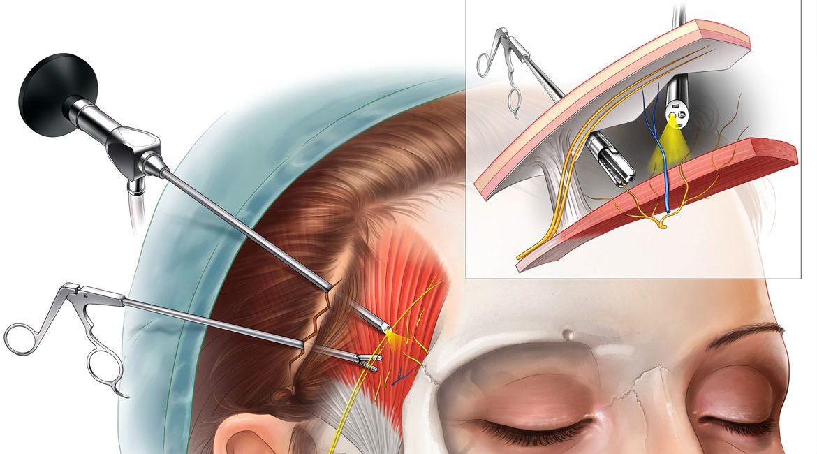 No place for Migraine Surgery (American Headache Association explained)