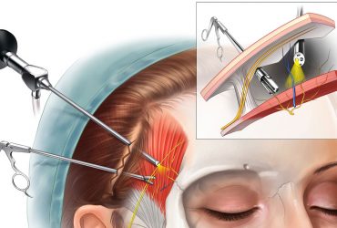 No place for Migraine Surgery (American Headache Association explained)