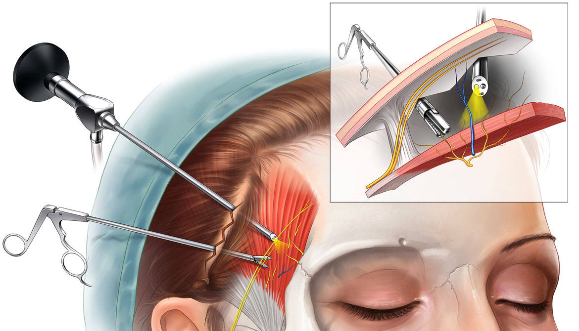 No place for Migraine Surgery (American Headache Association explained)
